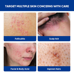 AOSORW crema foliculitis espalda: cuidado focal para la piel.