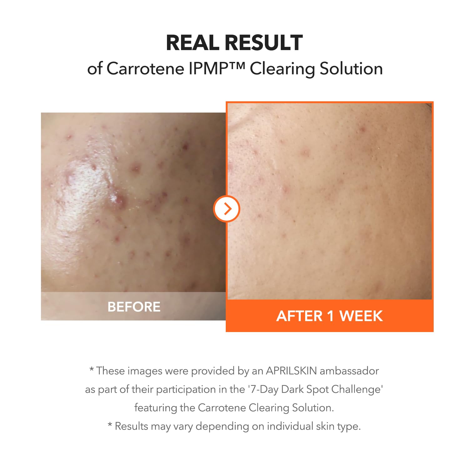 Zinc oxide al 1% en APRILSKIN Carrotene IPMP como ingrediente clave