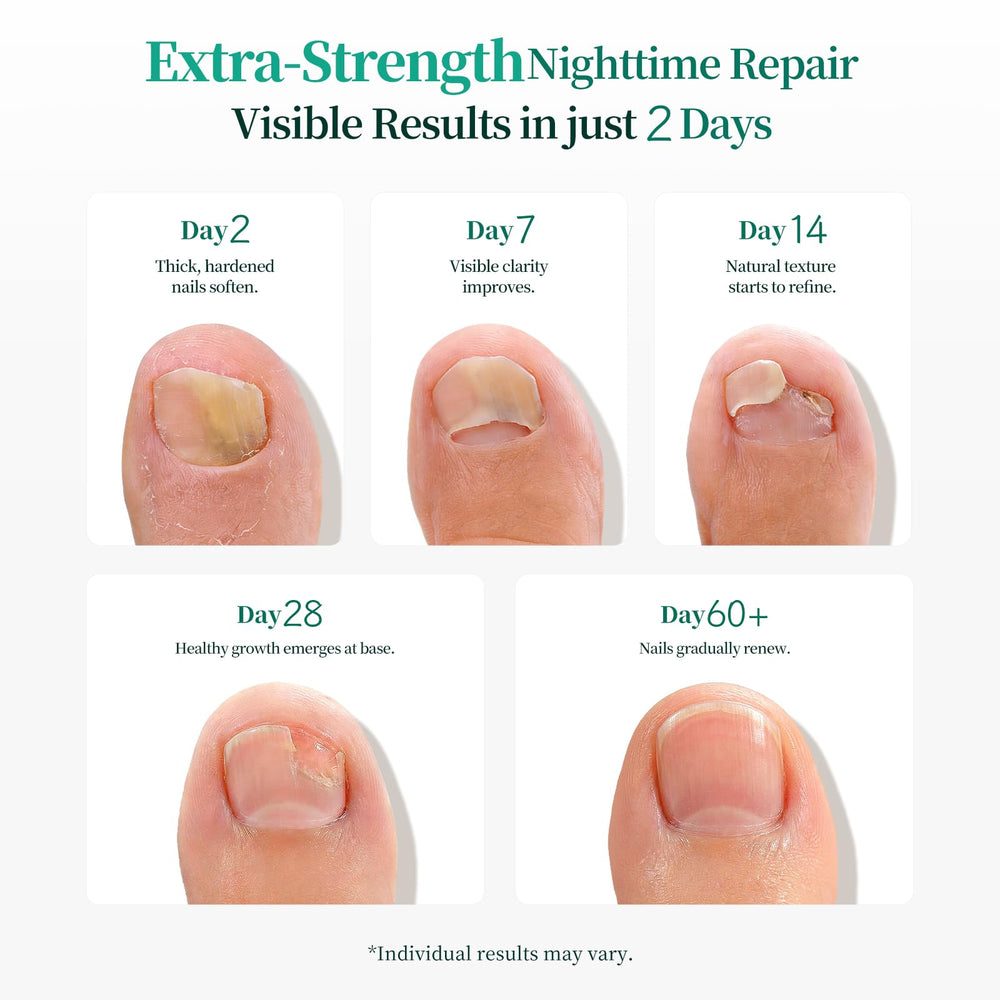 APUREE convenient, mess-free nail patch in use