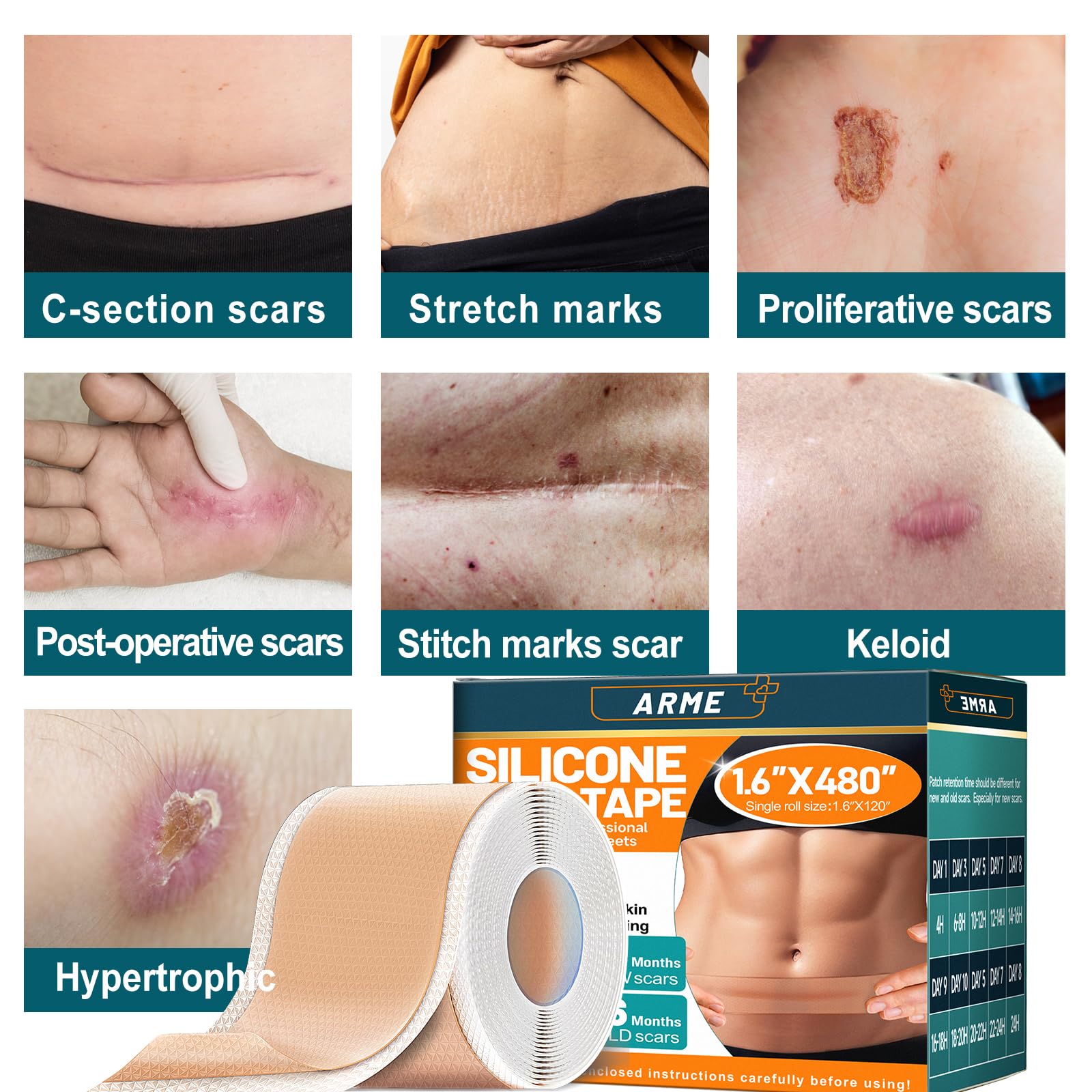Arme scar tape applied to C-section area demonstrating discreet coverage
