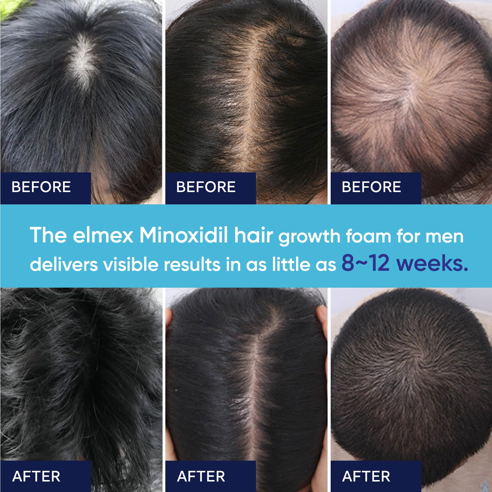 Man applying Artimore Minoxidil foam to beard area for possible growth support