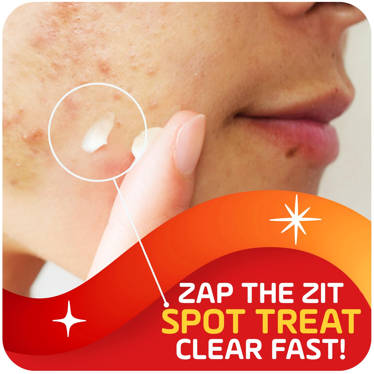 Asepxia penetration de poros para prevenir nuevos granitos y aclarar imperfecciones