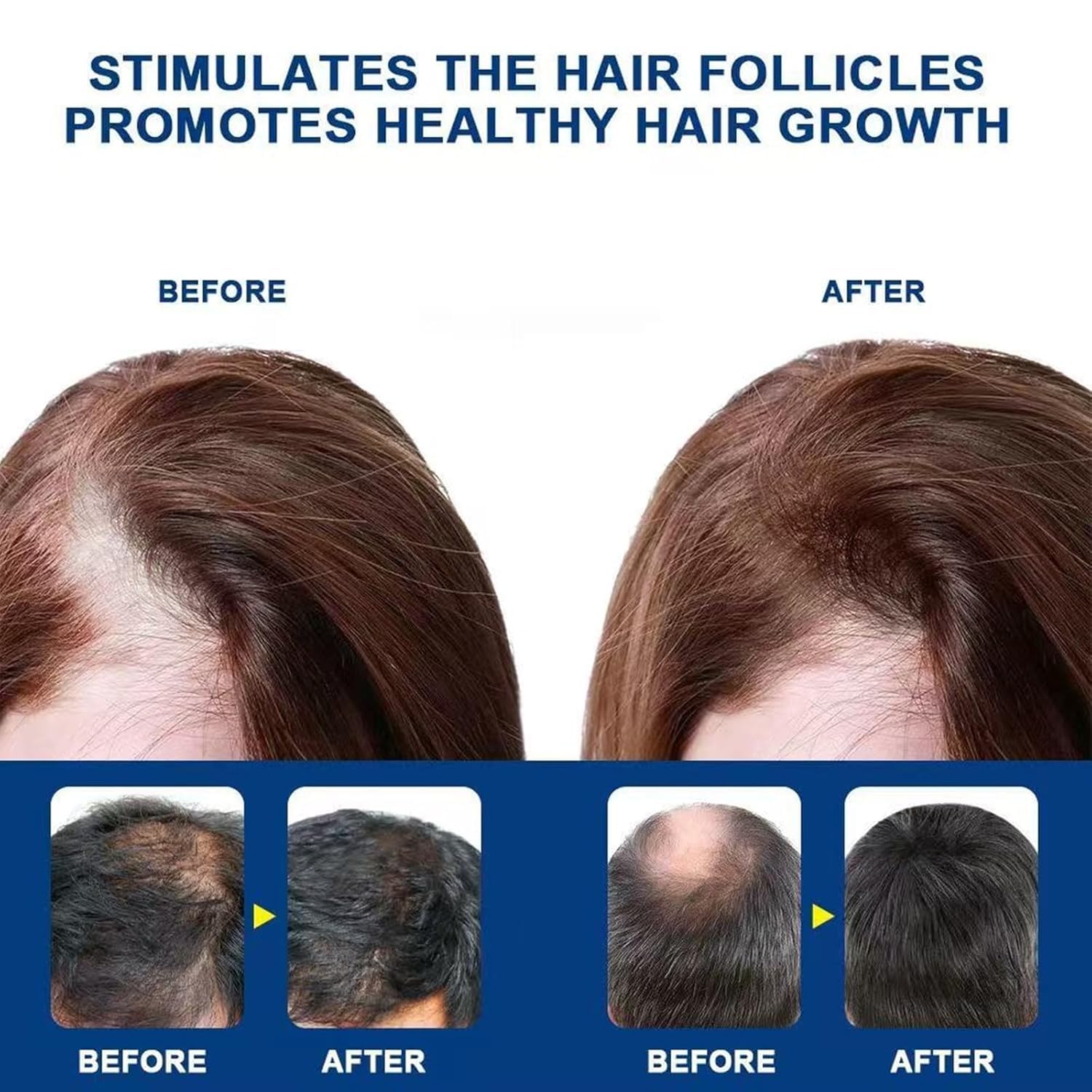 ATHNO Kormesic regeneración capilar suave con minoxidil 5%