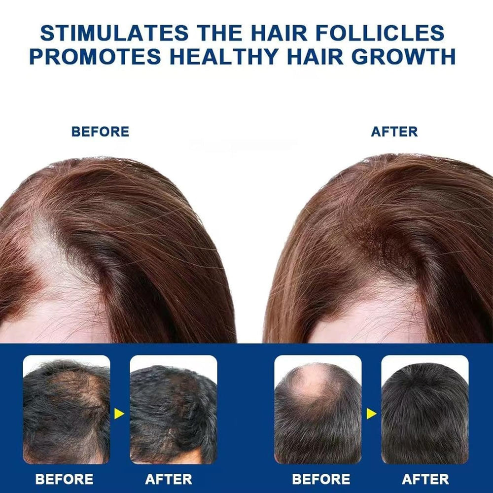 ATHNO Kormesic regeneración capilar suave con minoxidil 5%