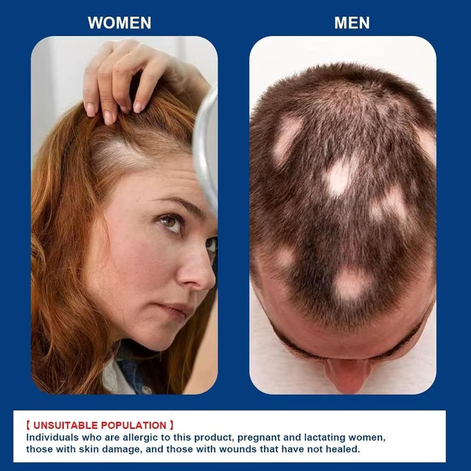 ATHNO Kormesic resultados de densidad y grosor en cabello y barba