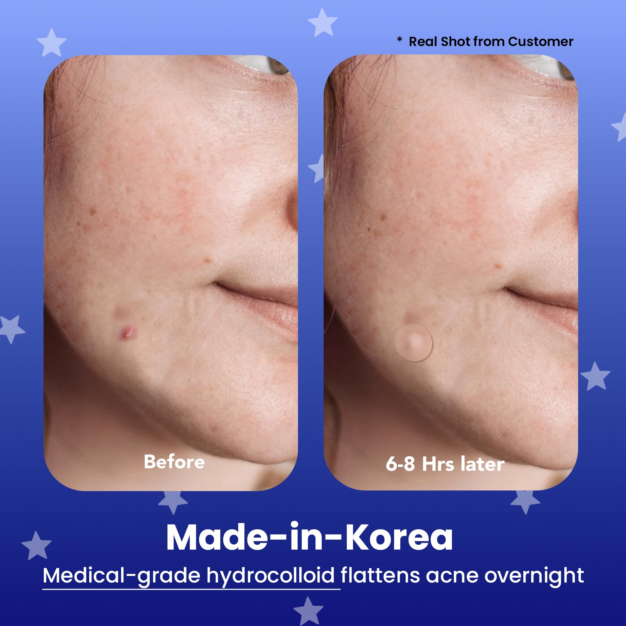 AVARELLE patch on face at night shows thin hydrocolloid shield for overnight blemishes