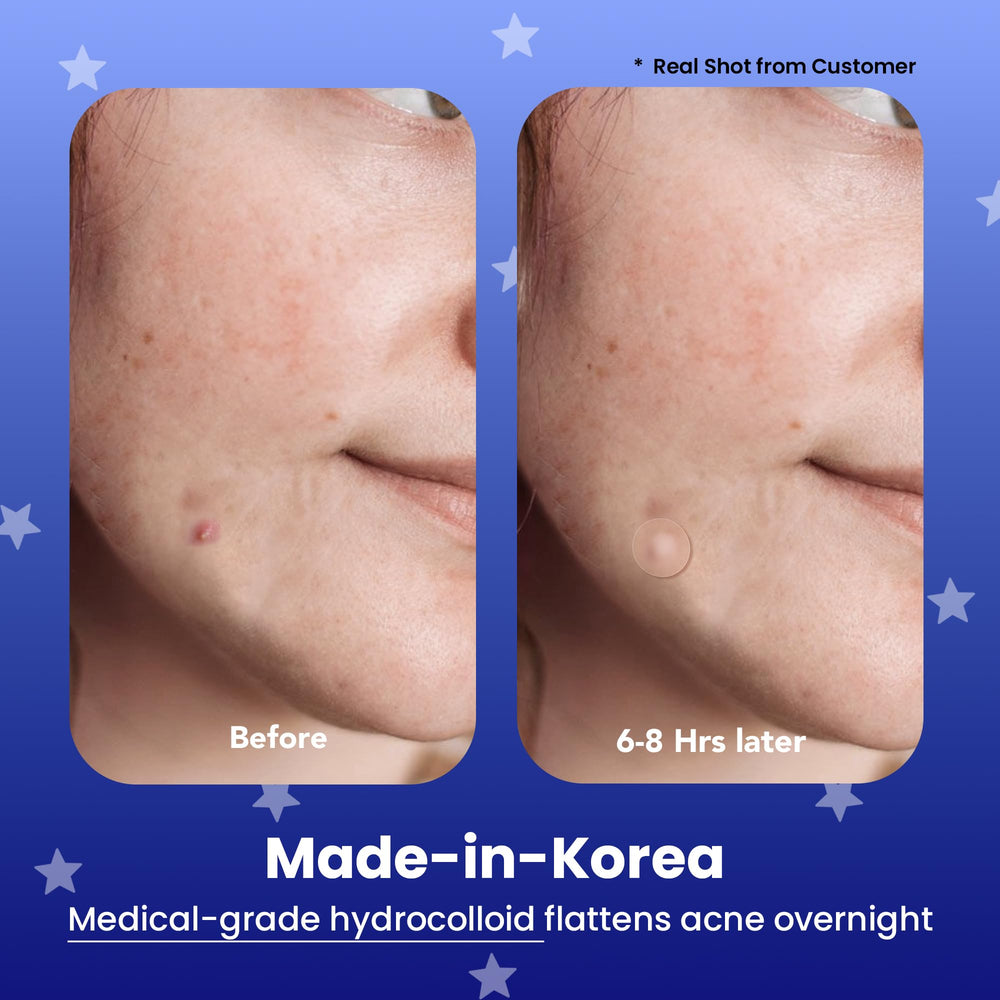 AVARELLE patch on face at night shows thin hydrocolloid shield for overnight blemishes
