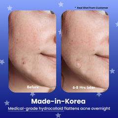 AVARELLE patch on face at night shows thin hydrocolloid shield for overnight blemishes