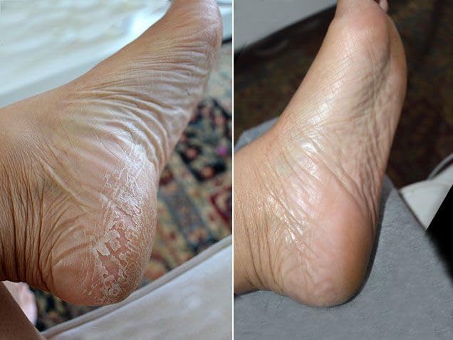 Baby Foot Exfoliation Peel close-up showing smooth feet