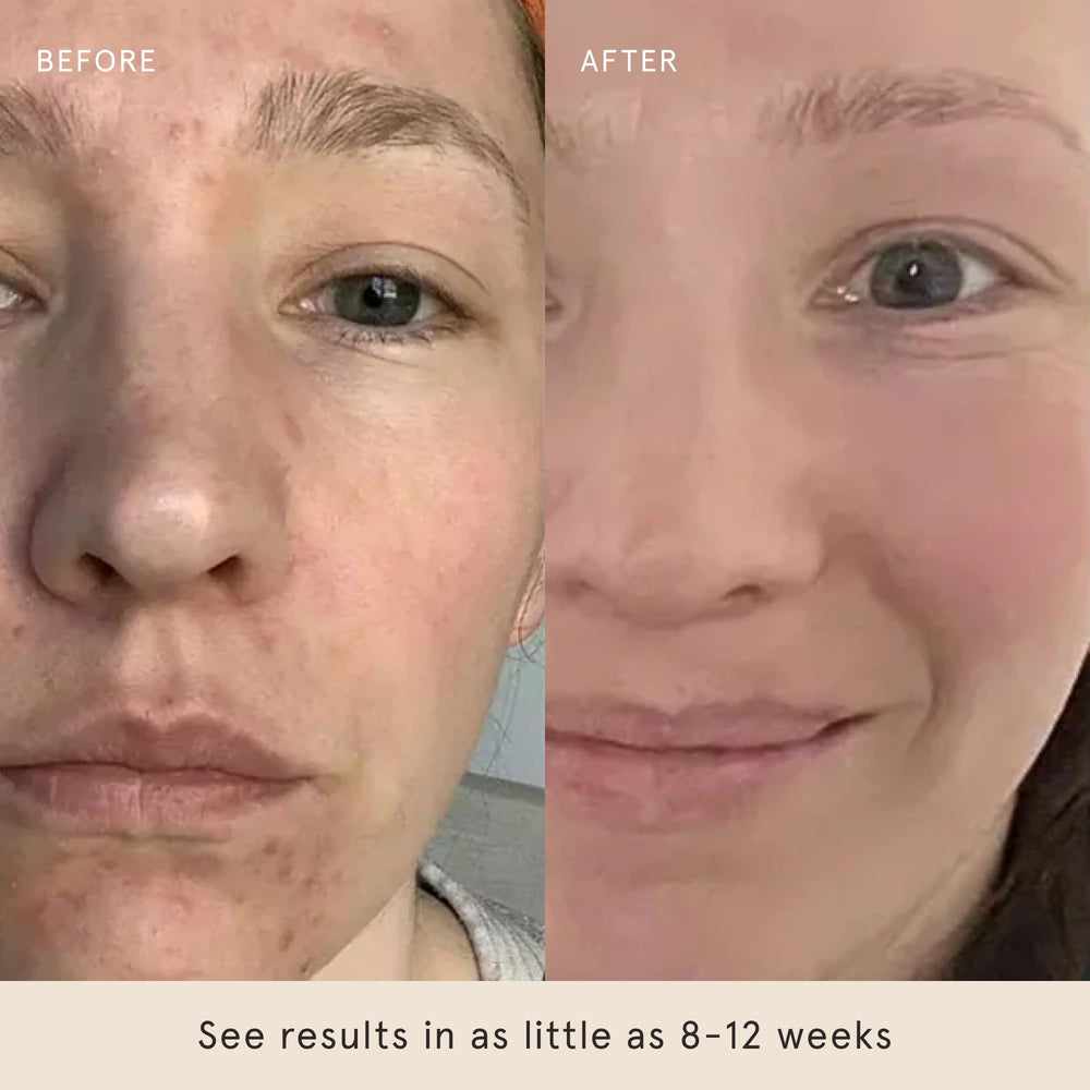 Barefaced Glow Peel Pad demonstrating clearer pores after use.
