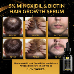 Beaueli minoxidil 5% foam applied to scalp for potential fullness.