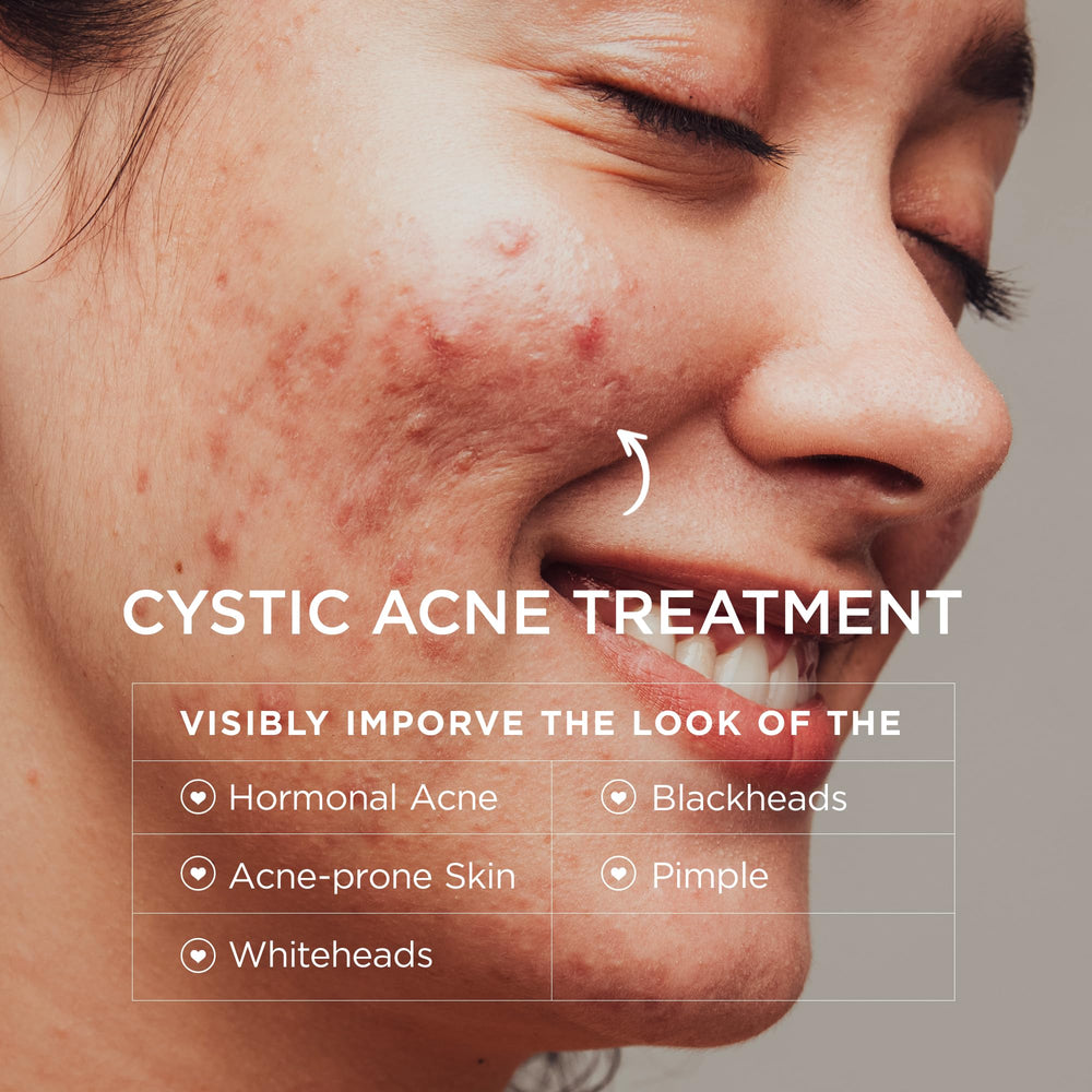 BellamiLuxx acne cream texture close-up highlights fast-absorbing formula for sensitive skin.