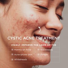BellamiLuxx acne cream texture close-up highlights fast-absorbing formula for sensitive skin.