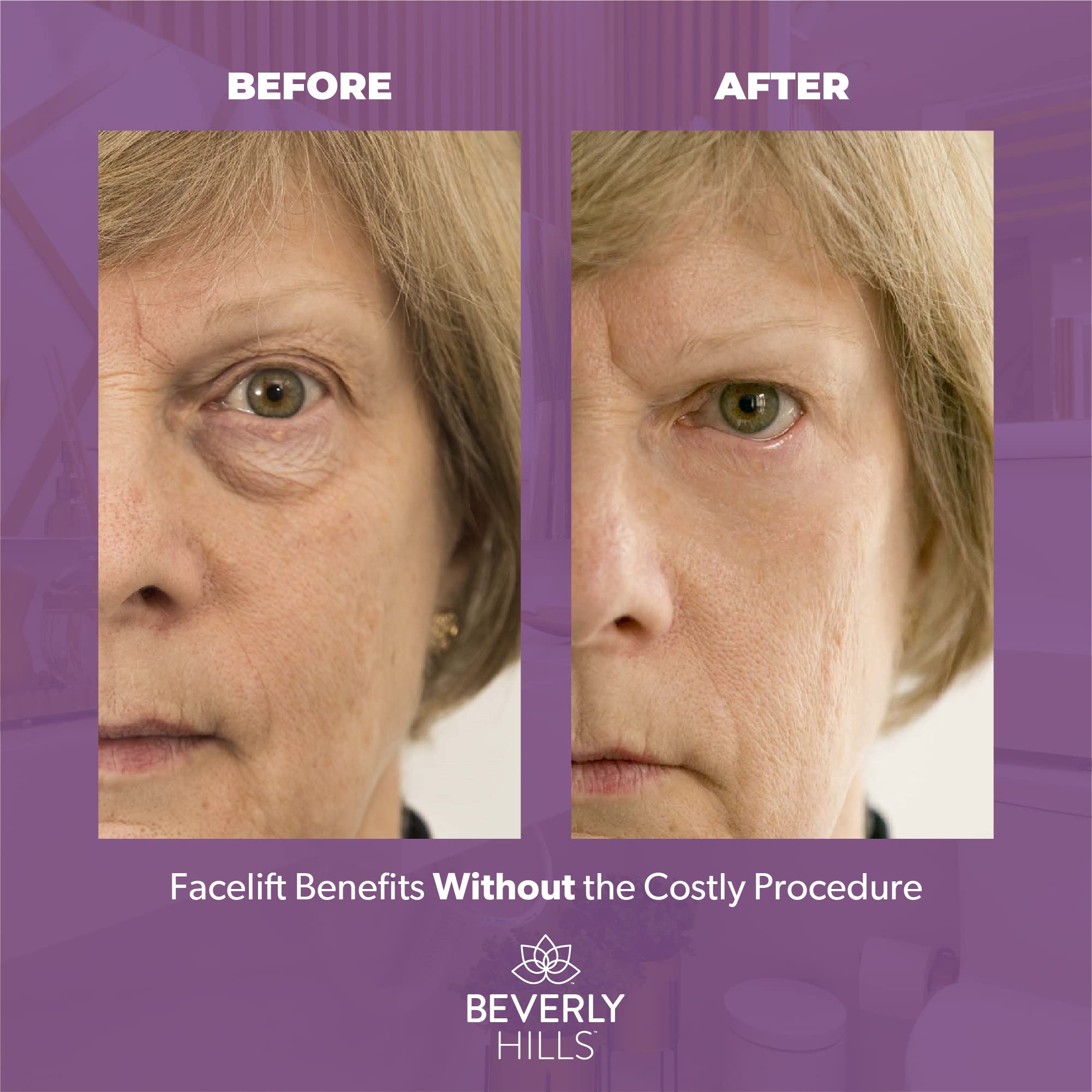 Beverly Hills under-eye area visual suggests reduced puffiness and added brightness.