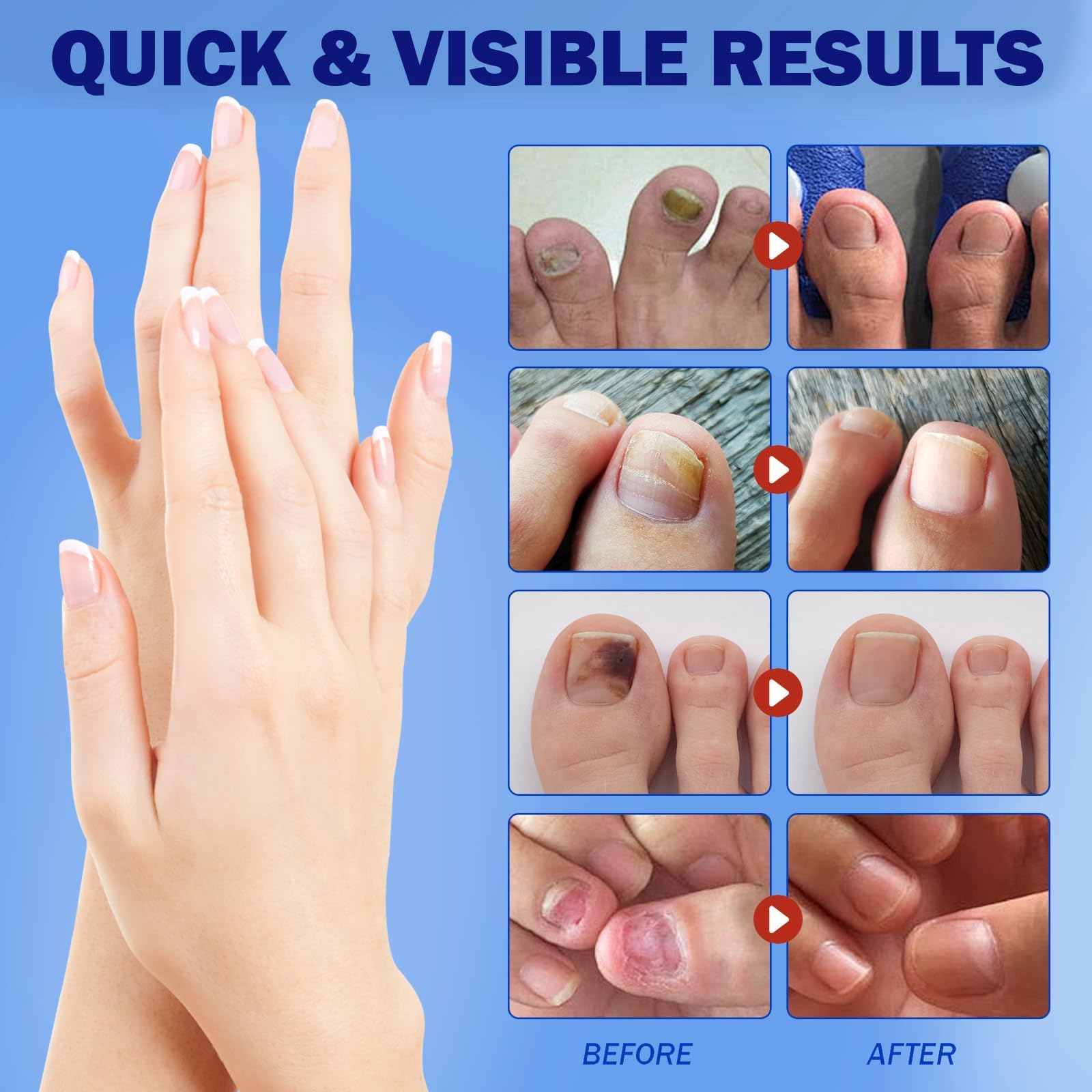 BFGCKJ regular-use patches support visible nail improvement over time.