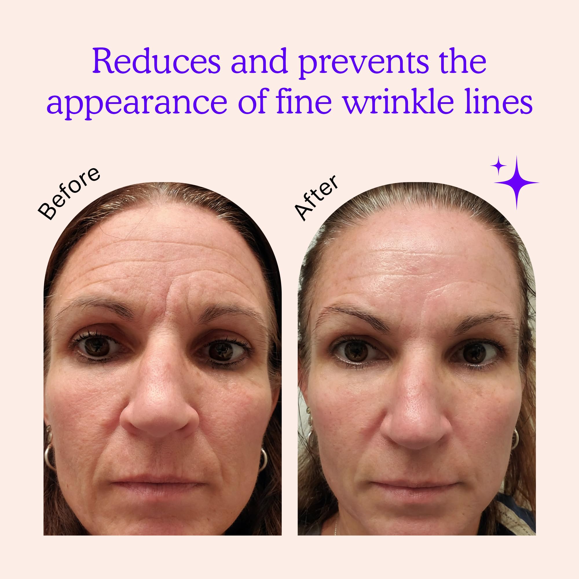 BLUMBODY forehead-wrinkles patch targeting brow lines overnight