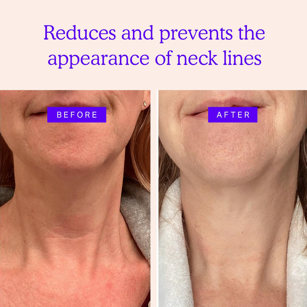 BLUMBODY neck wrinkle patches applied on skin for overnight wear