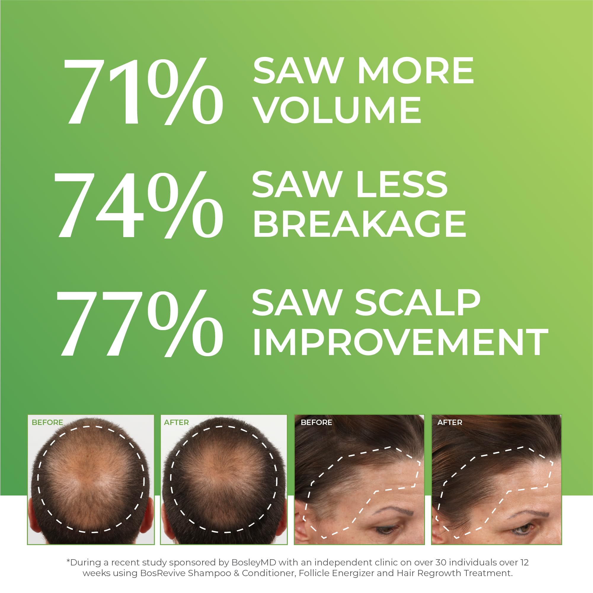 BosleyMD rosemary extract on hair scalp showcases anti-inflammatory support and improved microcirculation
