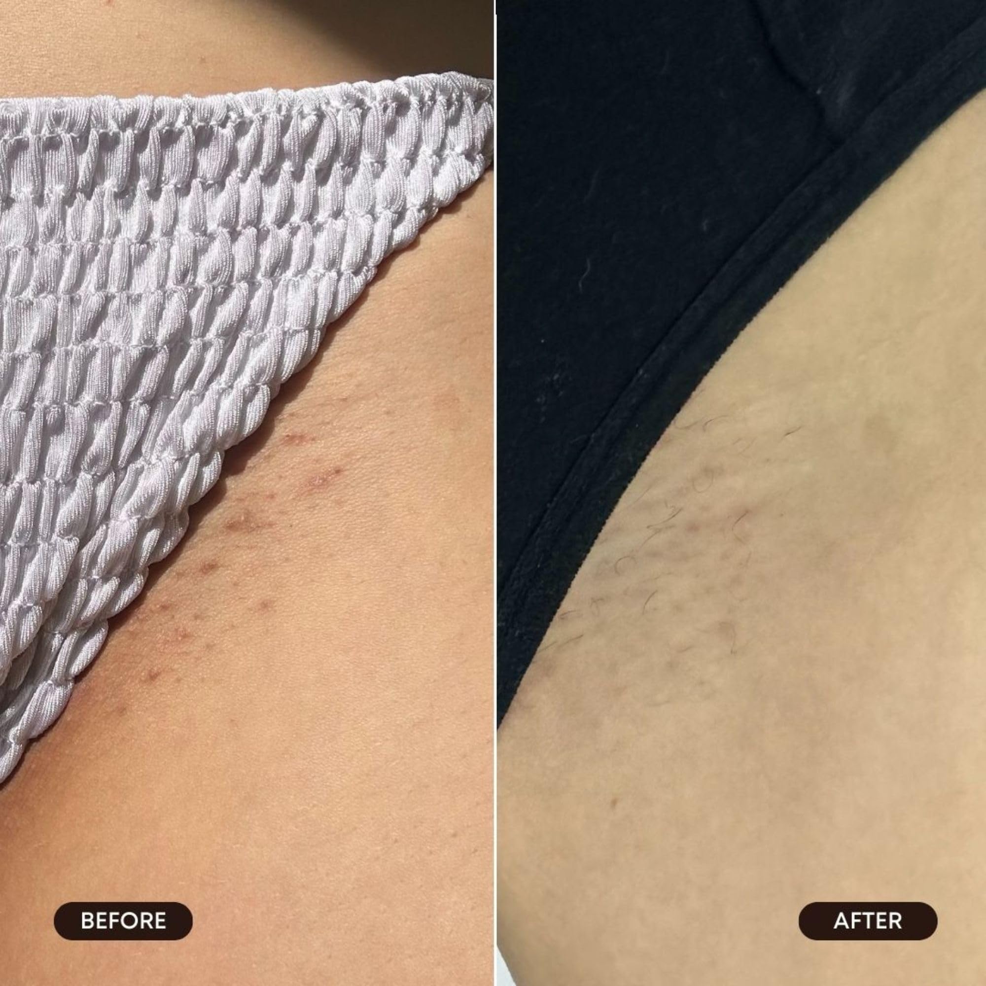 Aplicación post-depilación para piel más suave y cómoda