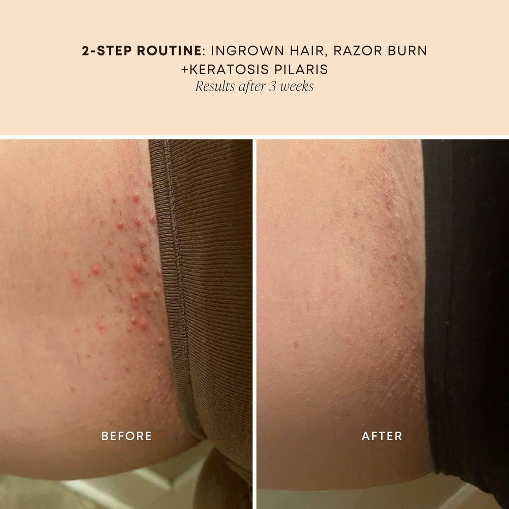 Bushbalm Ingrown Hair Oil application on skin for soothing relief