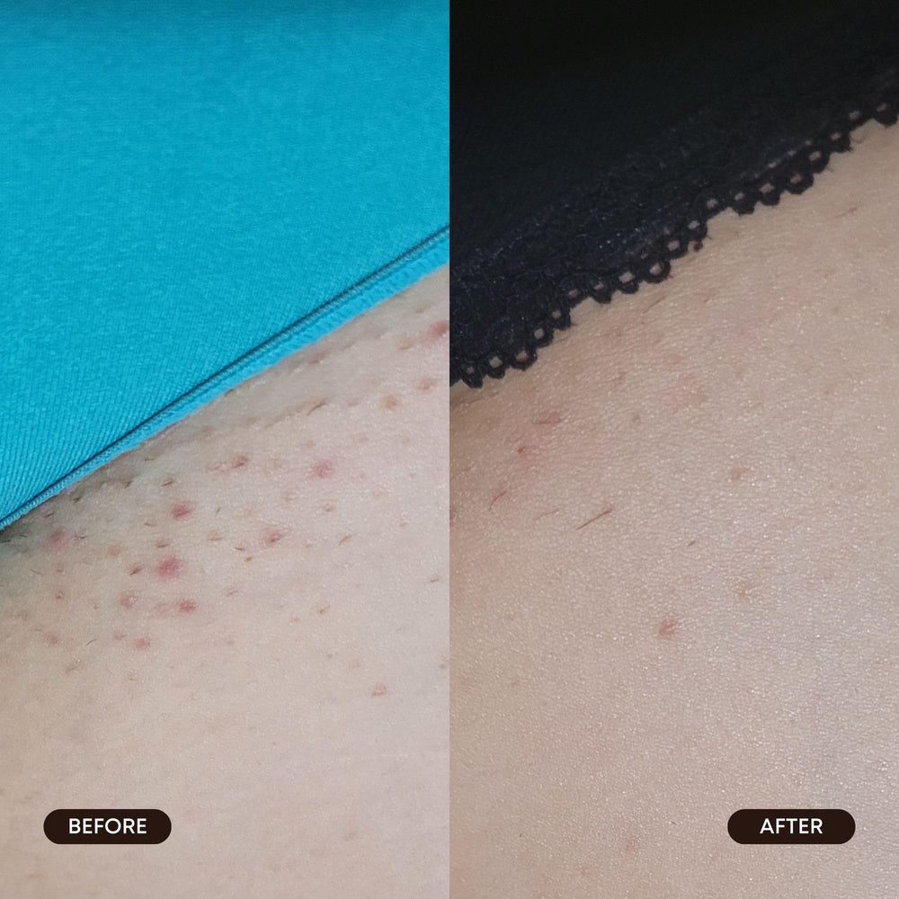Tiras exfoliantes Bushbalm para vellos encarnados visibles.