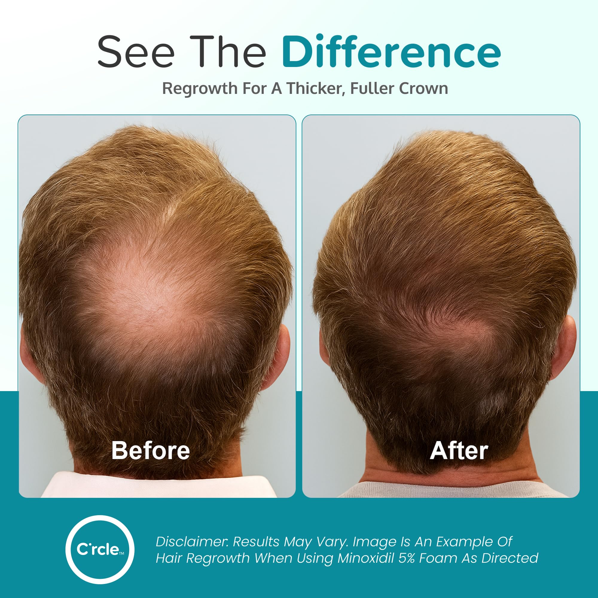 C'rcle Minoxidil 5% Foam even coverage across thinning scalp areas
