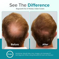 C'rcle Minoxidil 5% Foam even coverage across thinning scalp areas