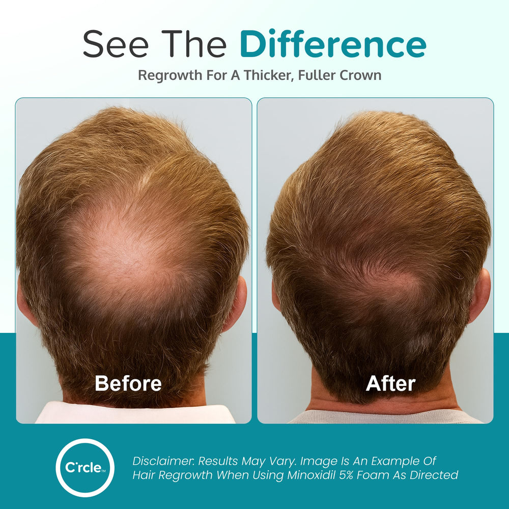 C'rcle Minoxidil 5% Foam three-month pack highlights extended supply.