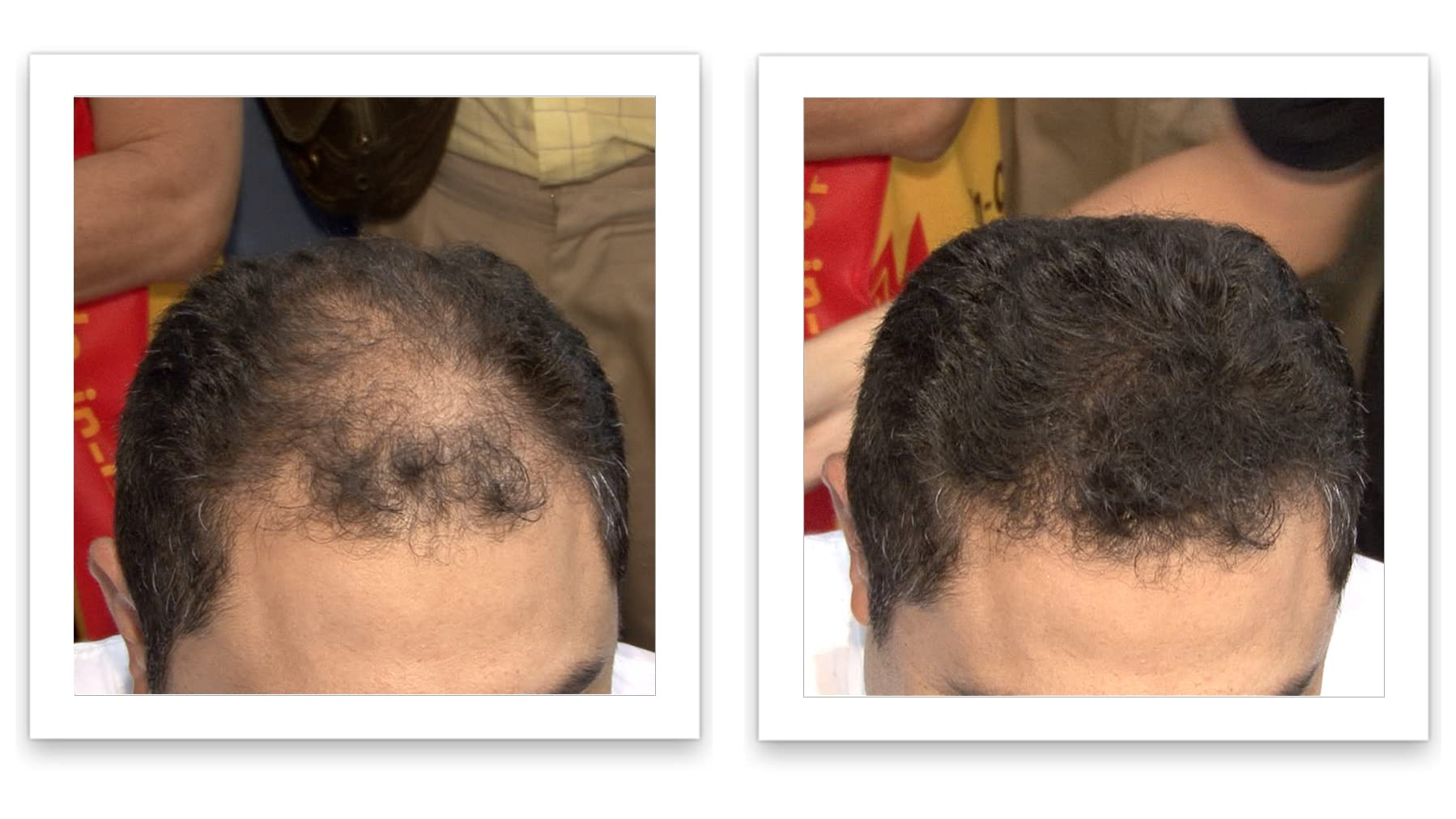 Caboki on thinning crown creates a denser appearance.