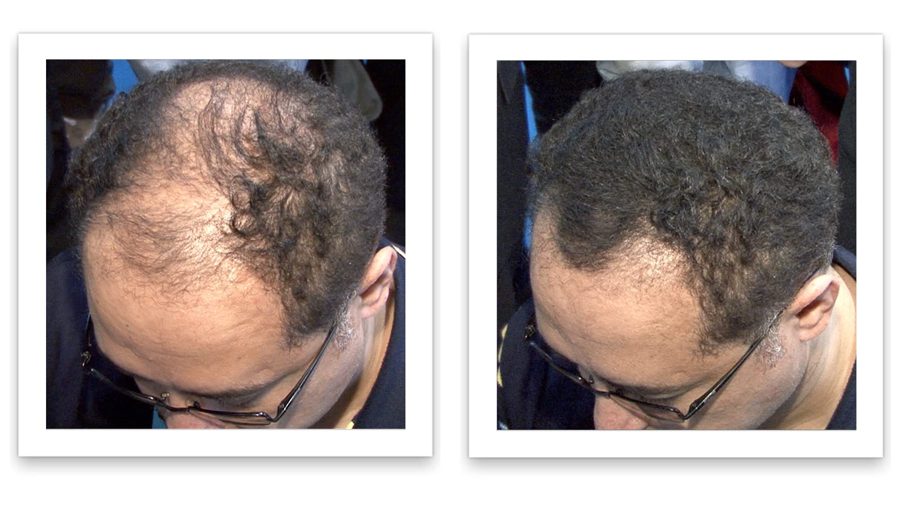 Close-up of Caboki fibers blending with natural hair for fuller-looking density.