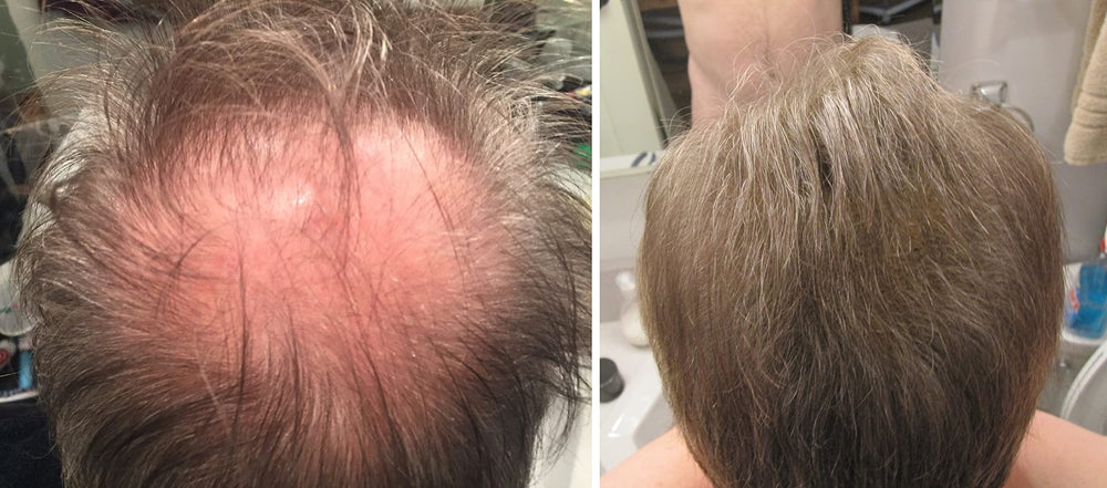 Applied to thinning crown area for a fuller natural look with Caboki.