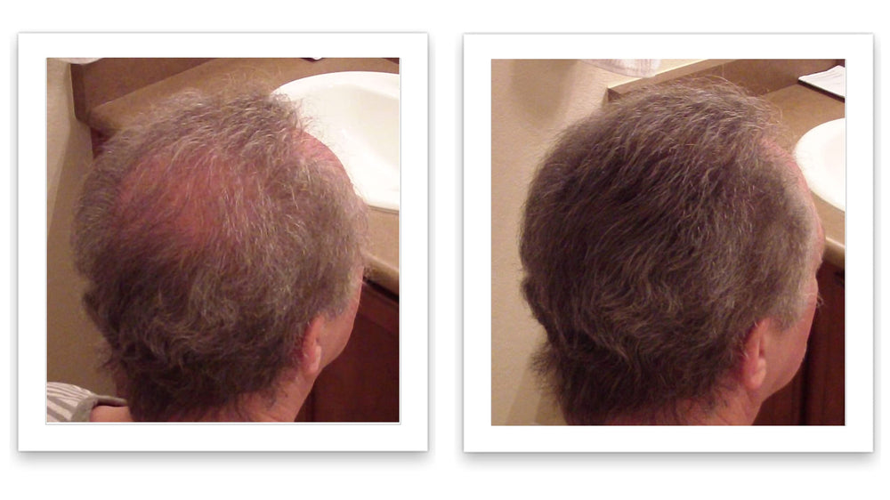 Designed for thinning crowns and receding hairlines with Caboki