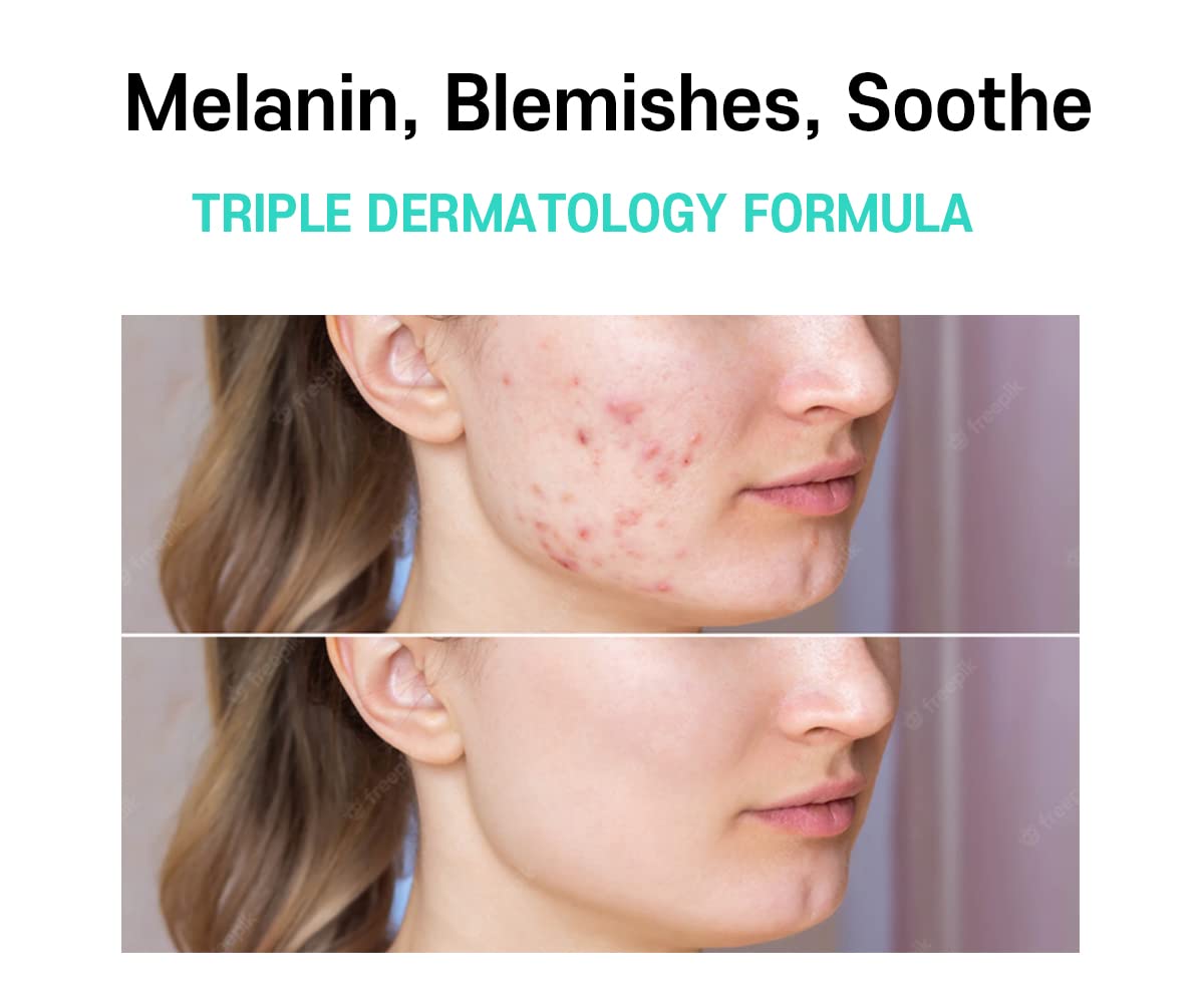 CARE:NEL Melasma crema con centella: efecto calmante para piel sensible.