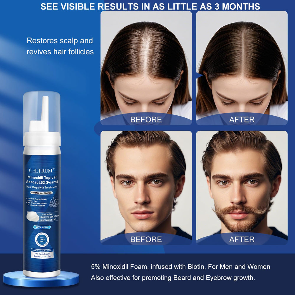Celtrum Minoxidil para cabello y barba con posibles mejoras de densidad.