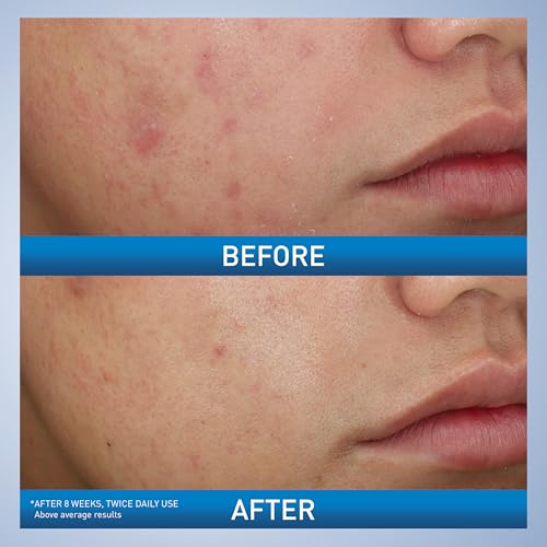 CeraVe peroxido benzoilo 10% en limpiador facial para piel clara.
