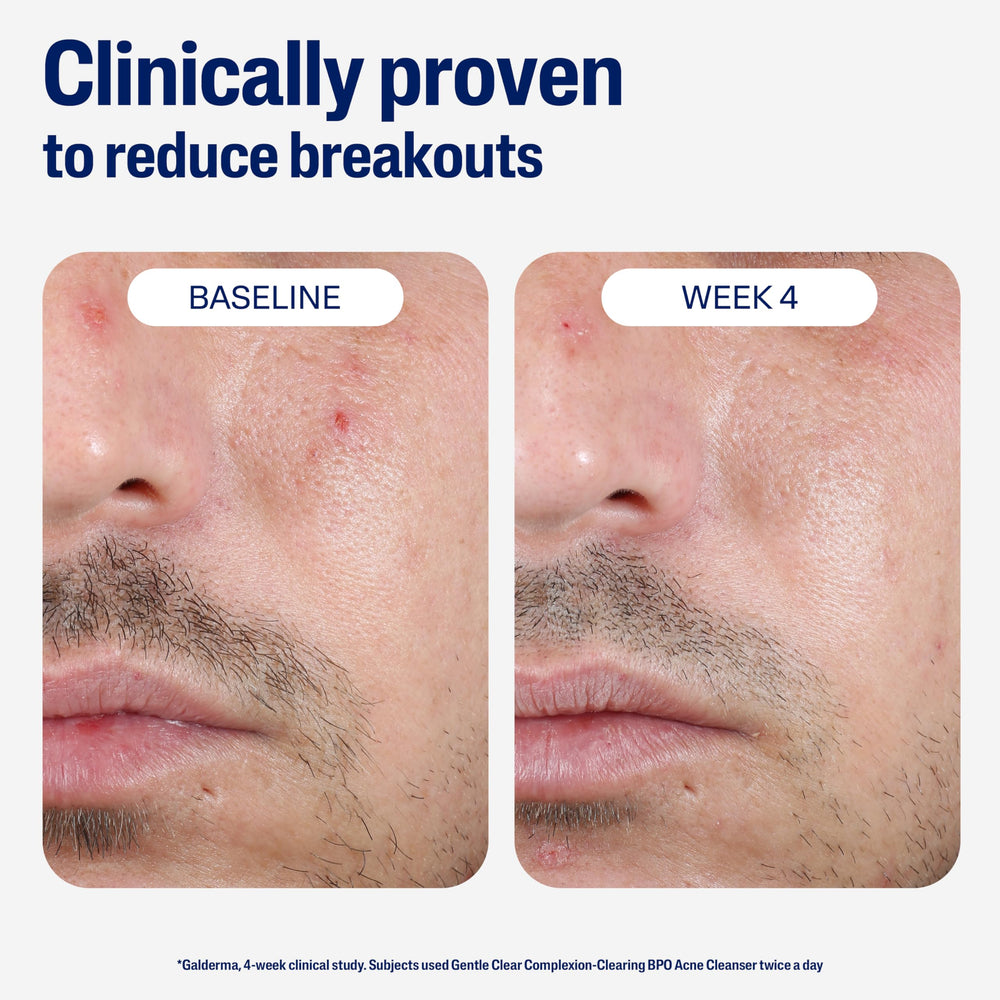 Cetaphil Gentle Clear packaging box emphasizing dermatologist-tested status