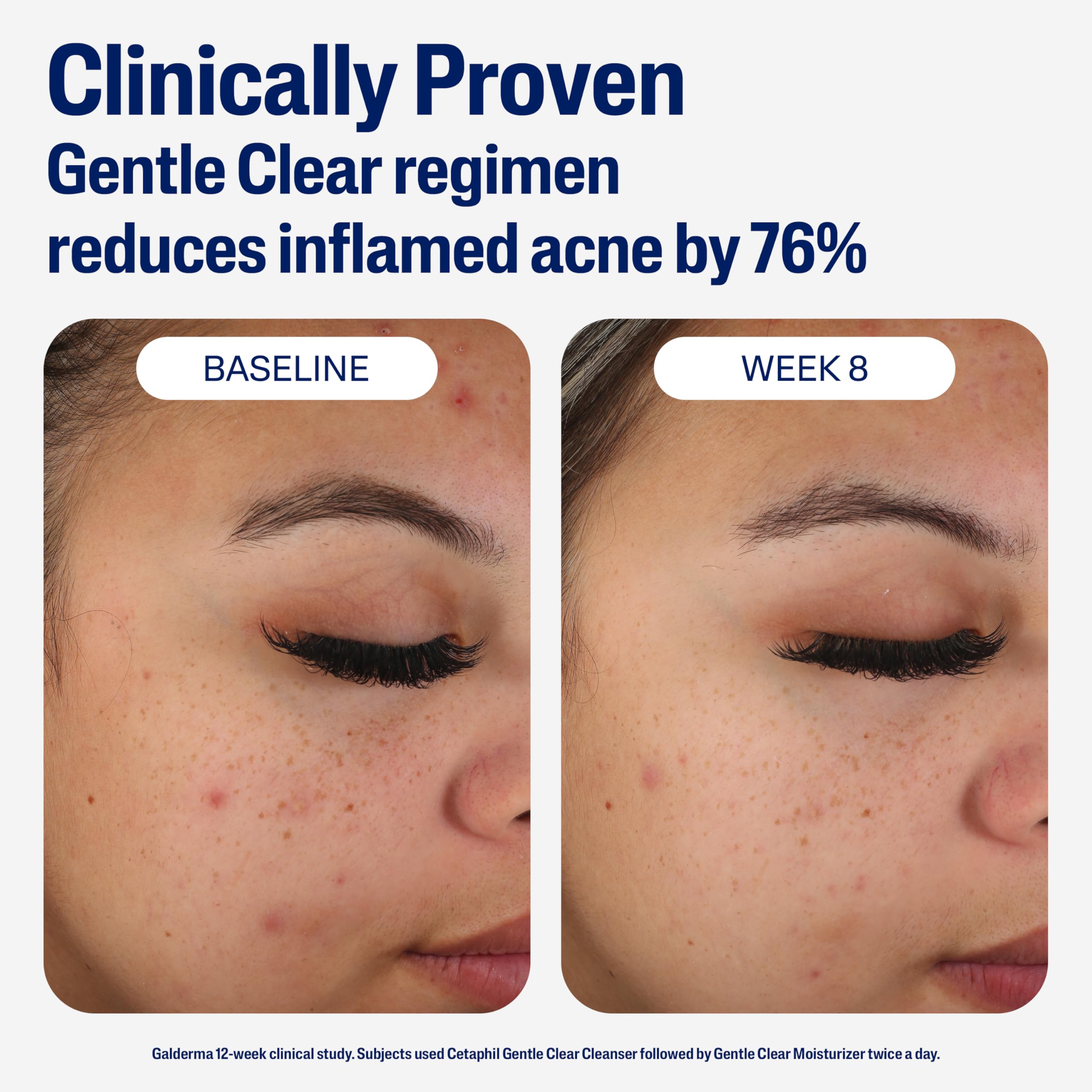 Cetaphil recomendado por dermatólogos para piel sensible con acné leve.