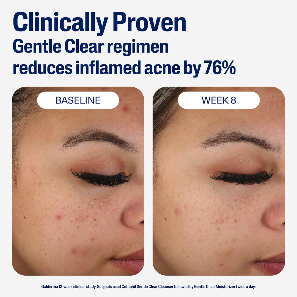 Cetaphil recomendado por dermatólogos para piel sensible con acné leve.