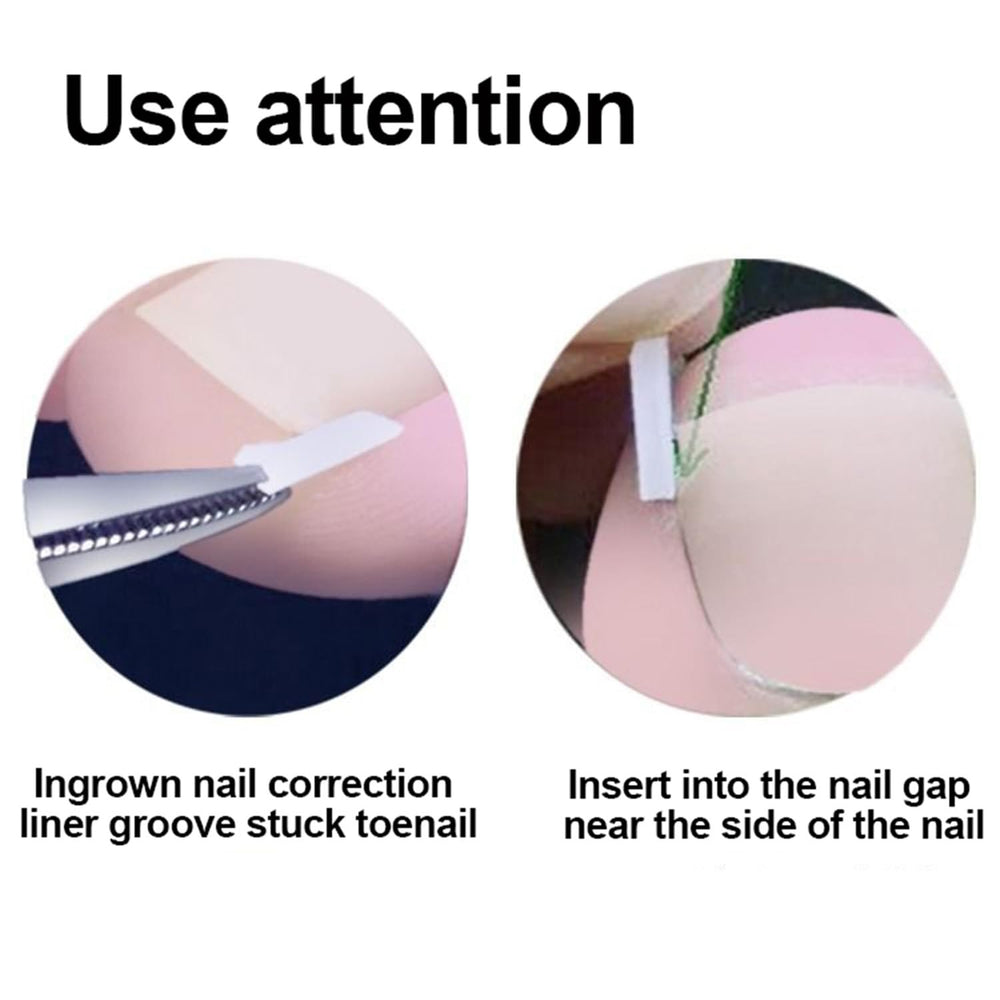 Chemailon curved toenail patch being applied for at-home care.