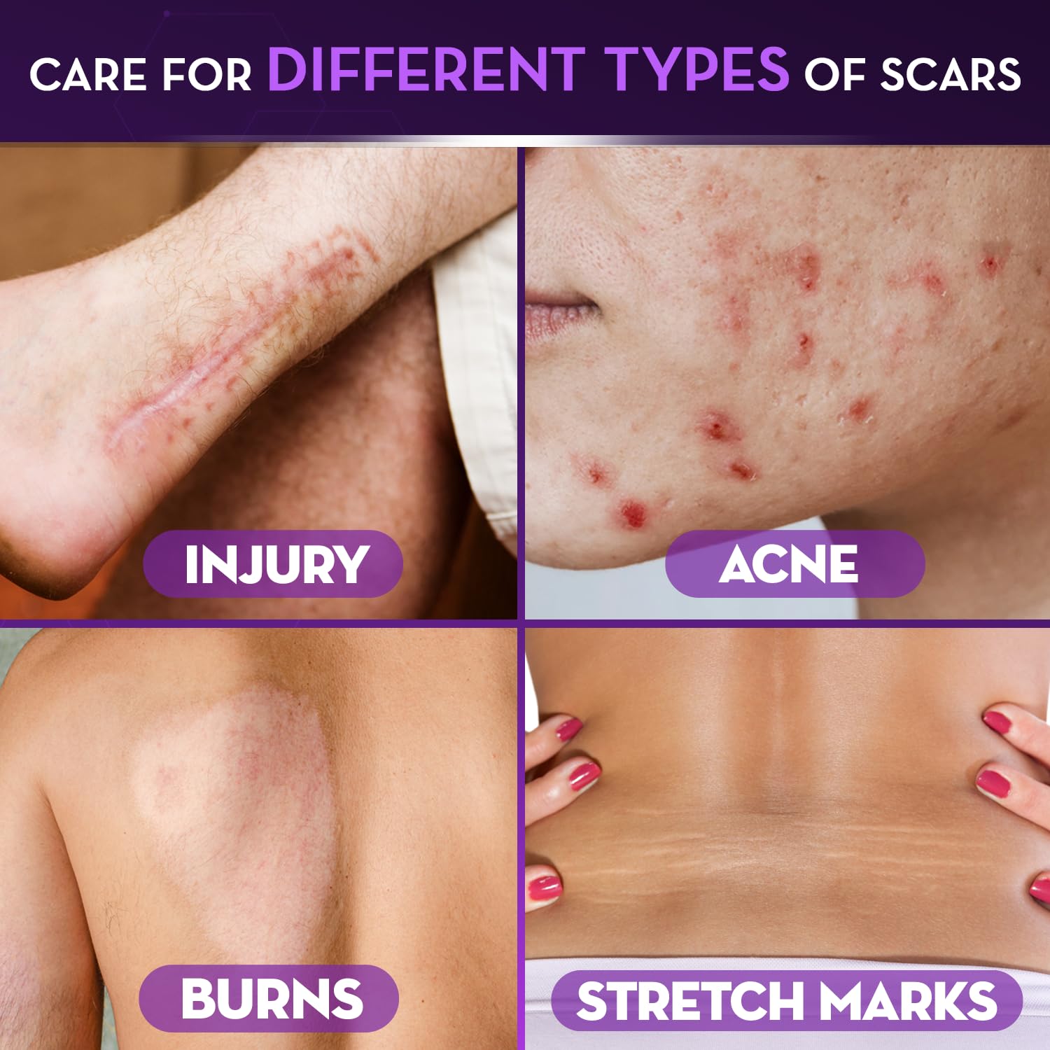 Cicatricure Advanced Scar Gel packaging displaying the 2 oz size for home care.