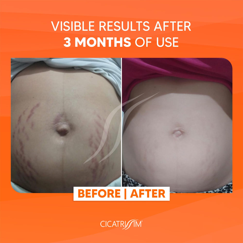 Cicatrissim cream highlighting skin firmness and hydration