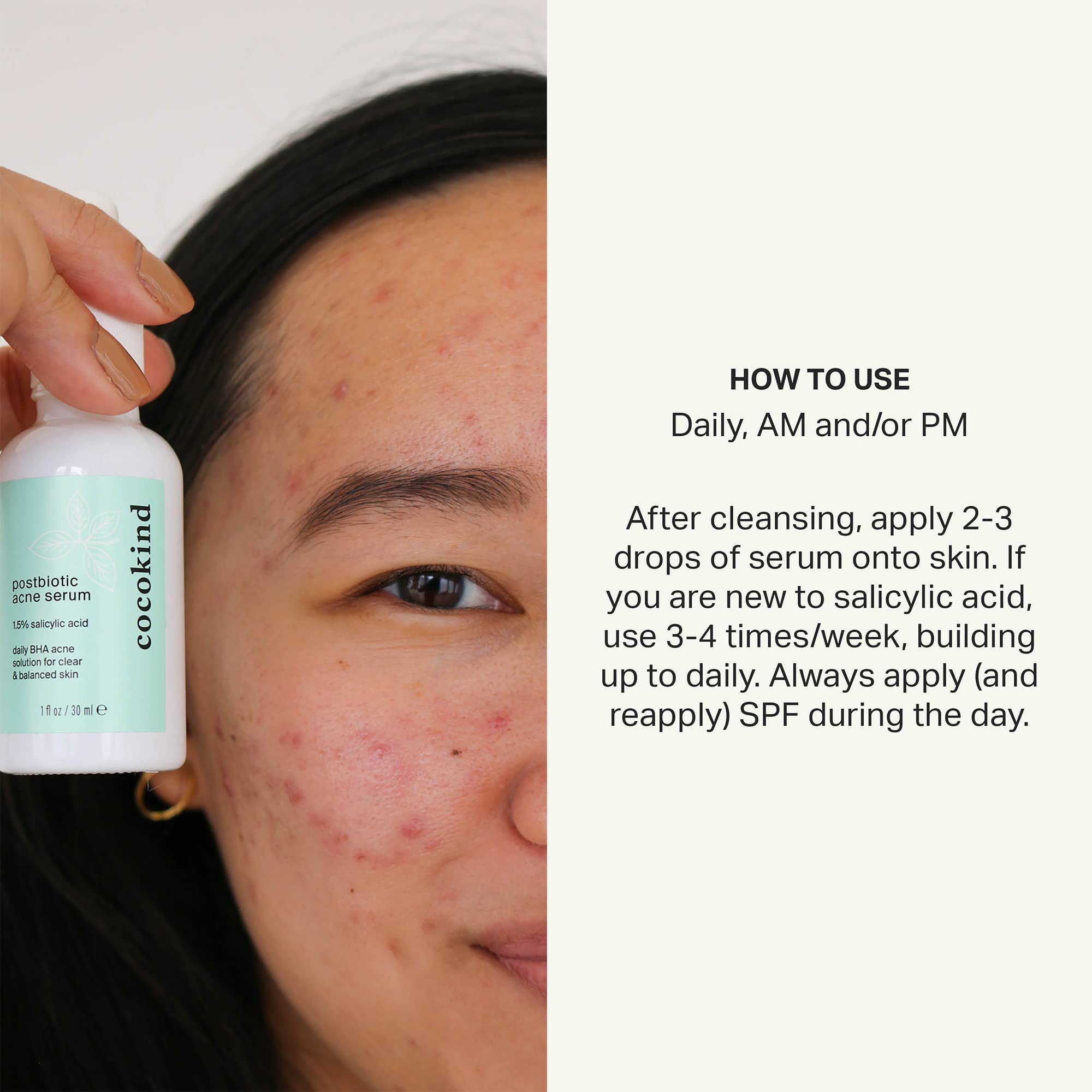 Cocokind Postbiotic Acne Serum con postbiotas y beta-glucano, para soporte de la barrera cutánea.