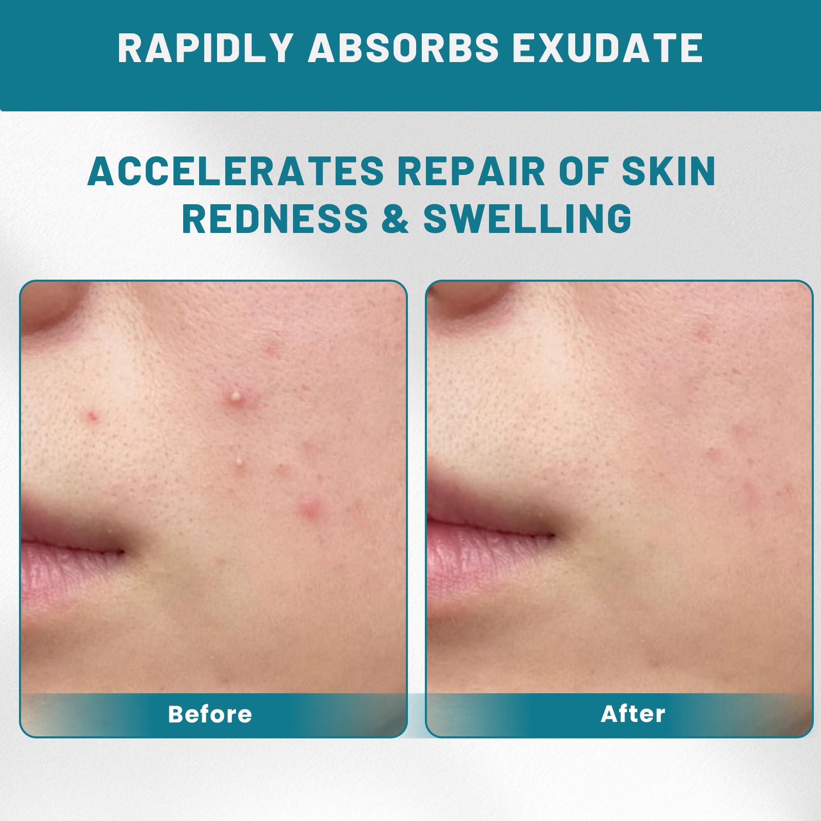 CUKWUYBY Pimple Patch Roll suitable for daily acne care without irritation
