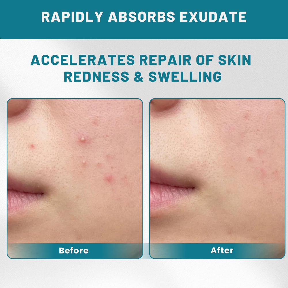CUKWUYBY Pimple Patch Roll suitable for daily acne care without irritation