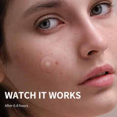 Daolyo Pimple Patches with tea tree oil support gentle cleansing.