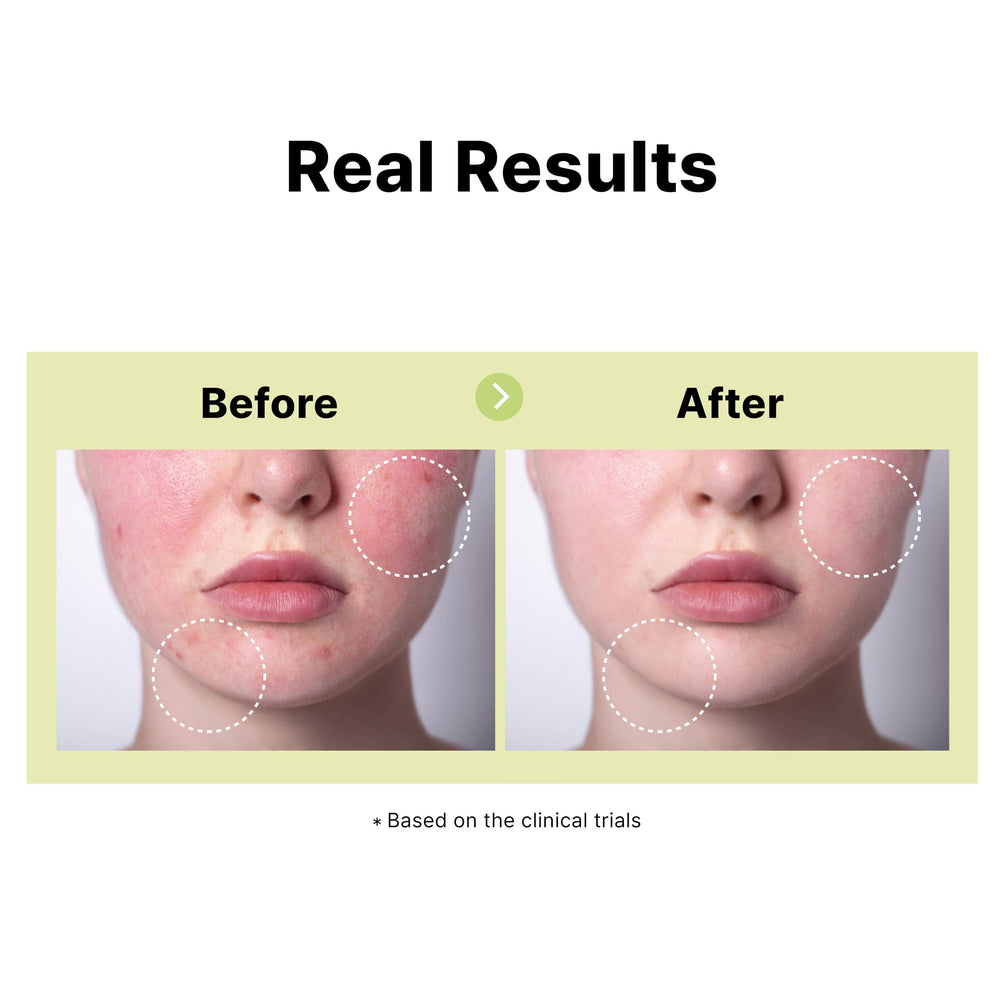 DearMYDEW Serum Azelaico 10% aplicación diaria, piel uniforme.