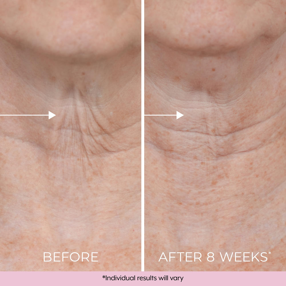 DEKLIDERM crepey neck skin improvement visualized on neck area.