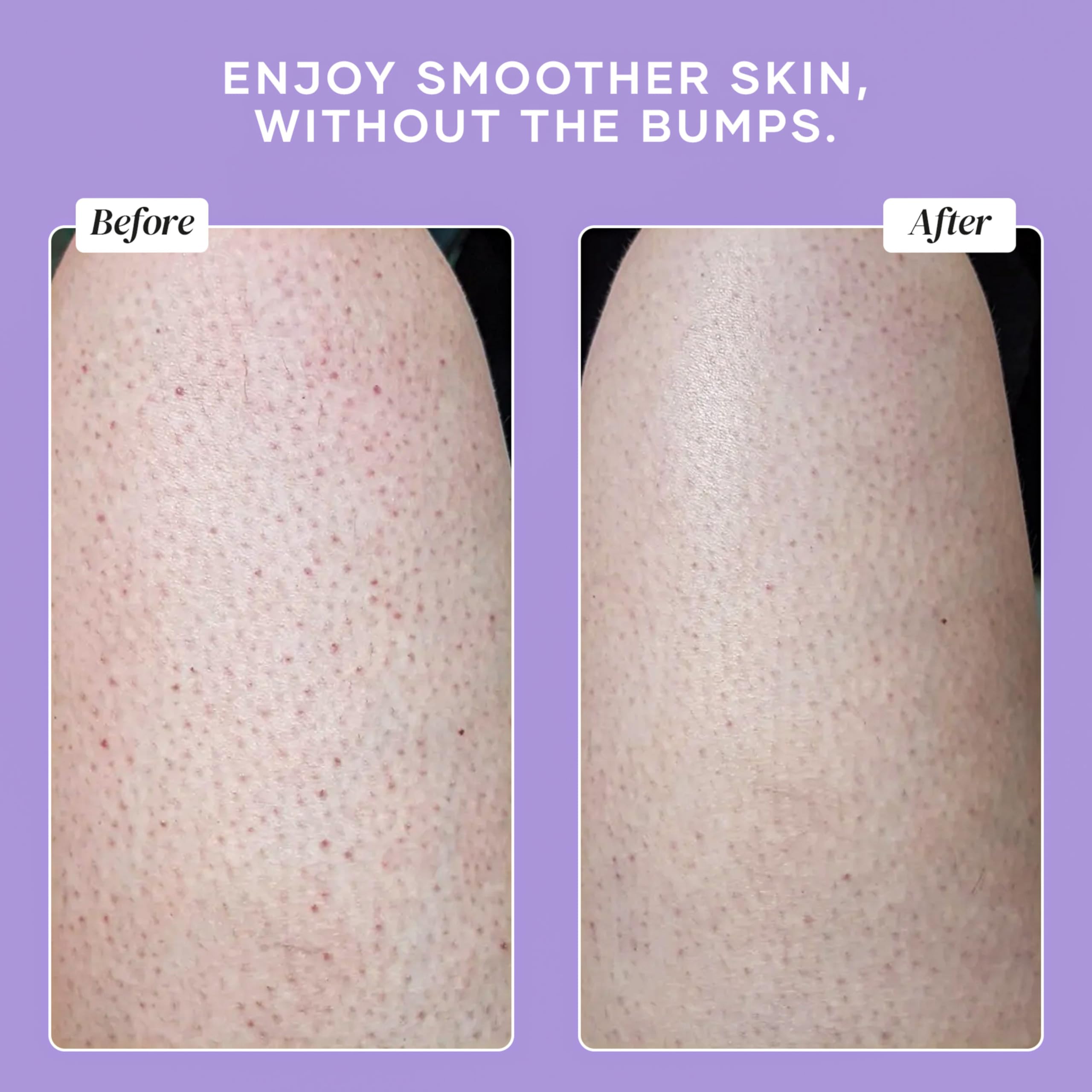 Glycolic and lactic acids in the formula for deep exfoliation