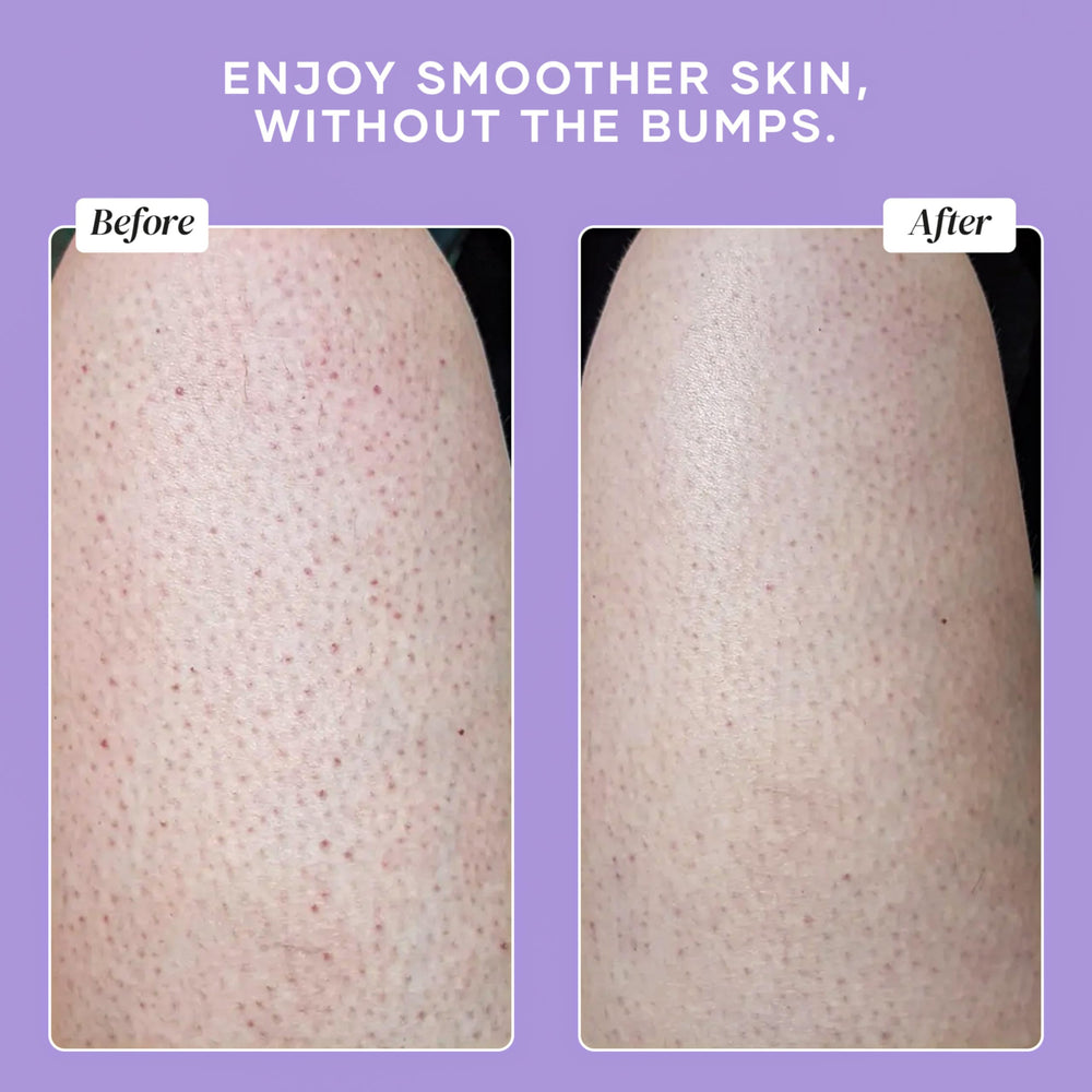 Glycolic and lactic acids in the formula for deep exfoliation