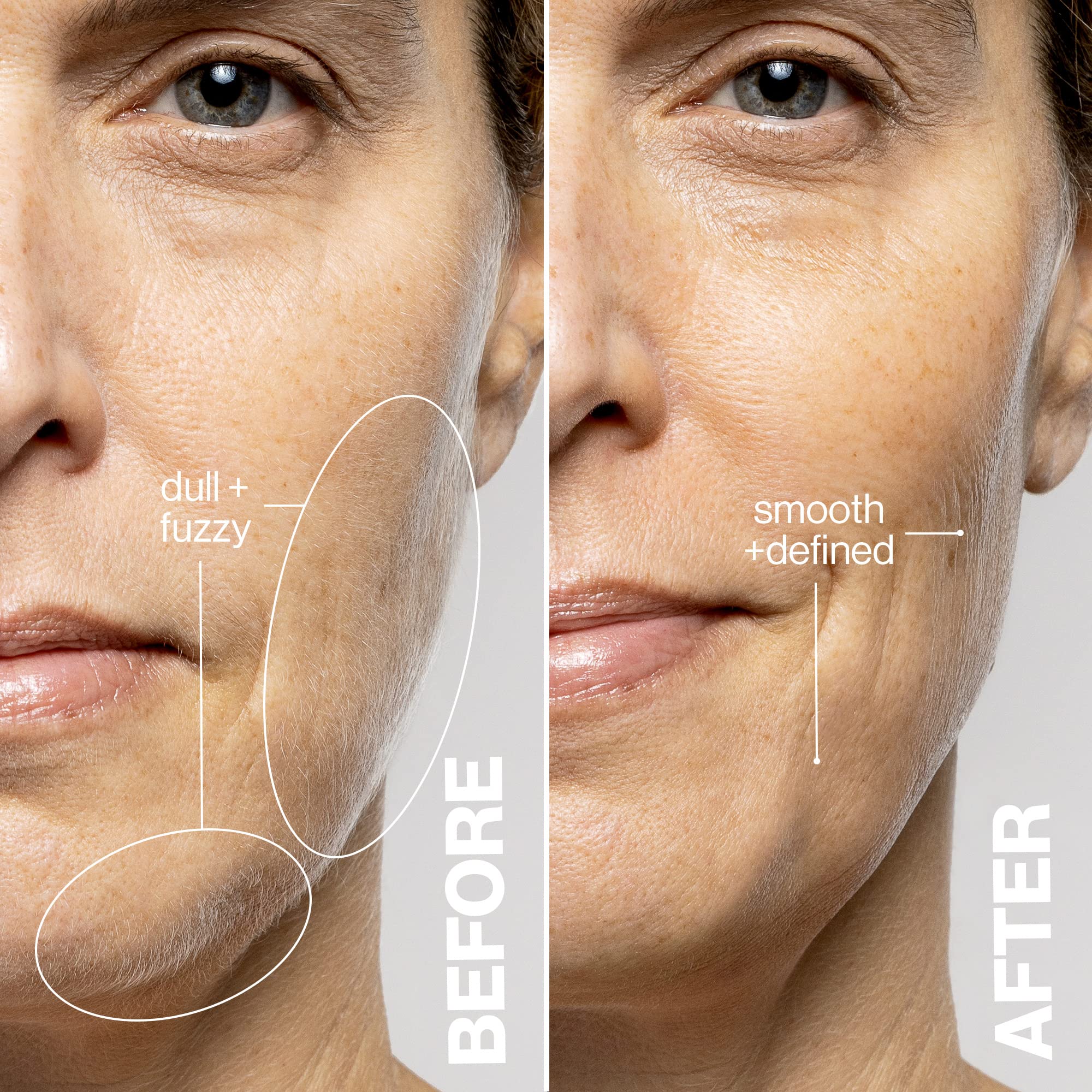 DERMAFLASH LUXE+ safety cage close-up protecting skin during dermaplaning